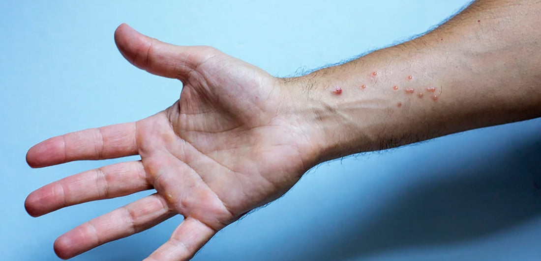 arm with poison ivy rash blisters