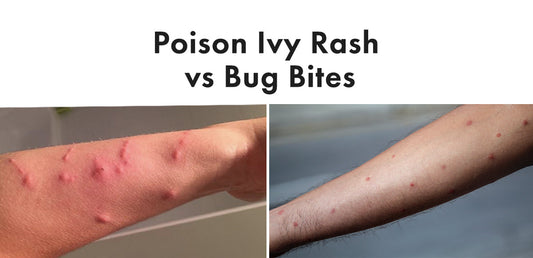 Arm with bug bites compared to arm with poison ivy rash