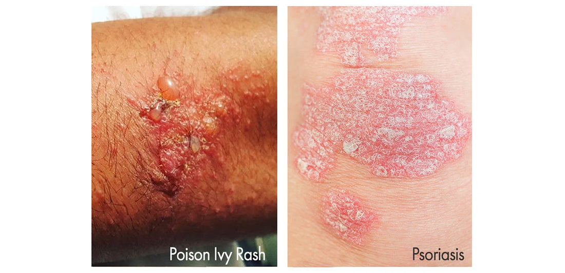 Poison ivy rash and psoriasis patch on skin