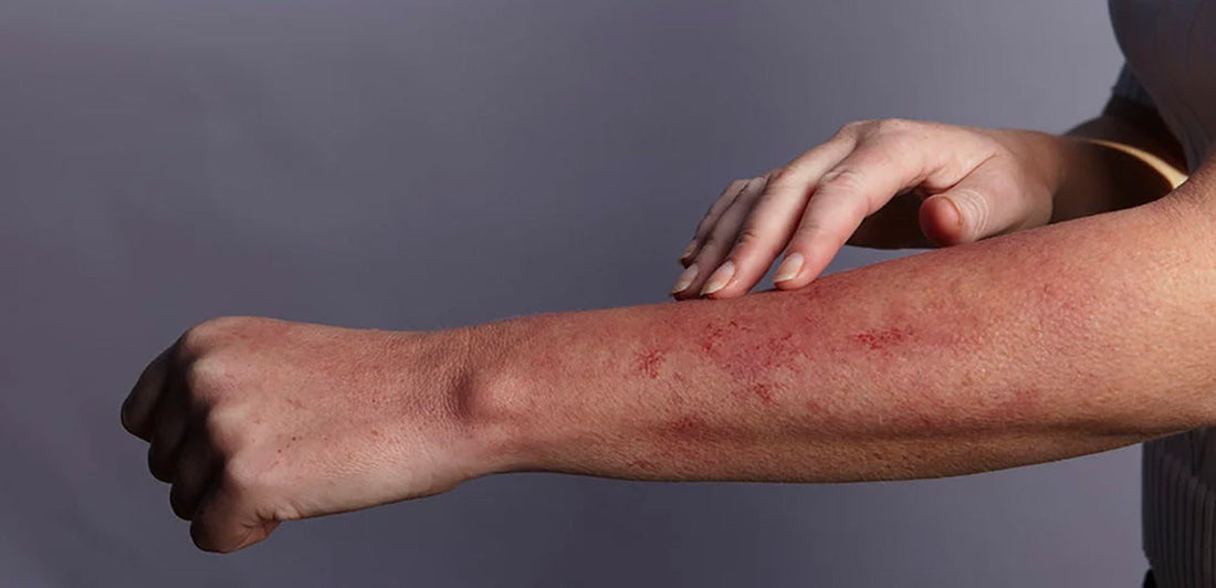 arm with rash