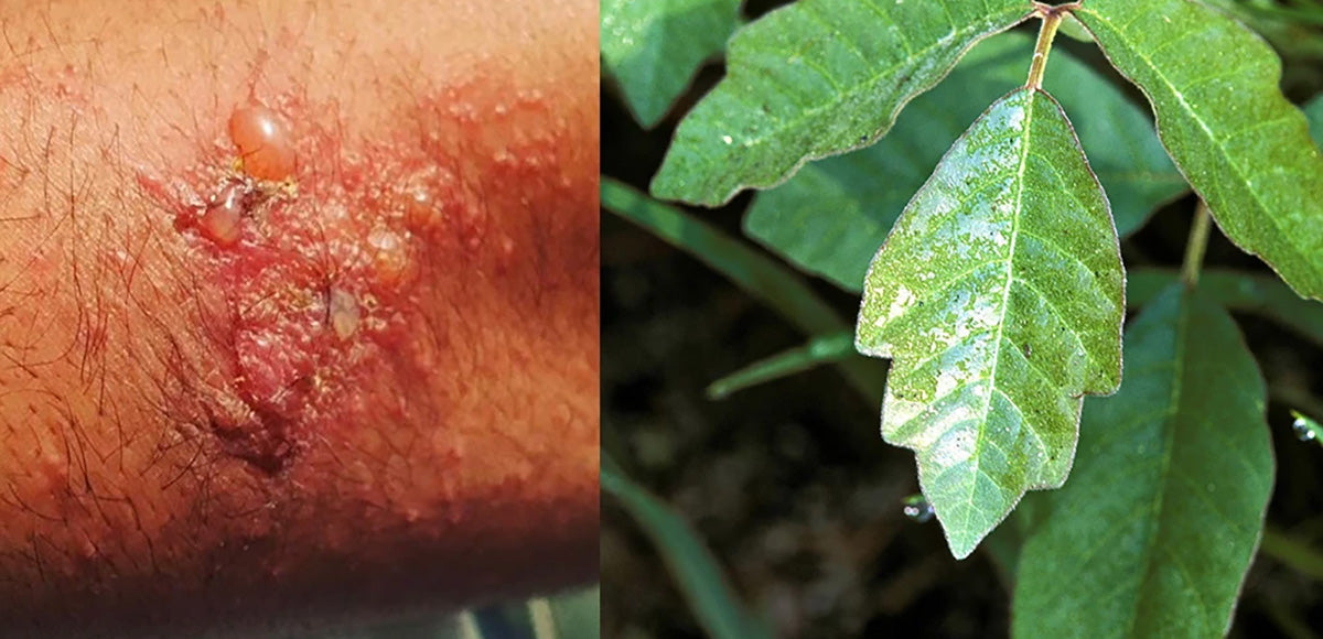 Oak Pollen Rash Poison Oak Rash: What It Looks Like & How To Treat It – Tecnu