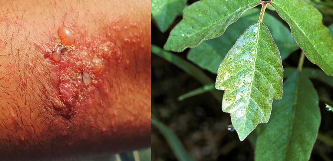 Poison oak rash image next to poison oak plant image