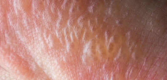 blisters from poison ivy rash