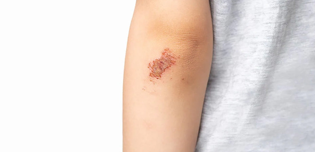 Scab on elbow