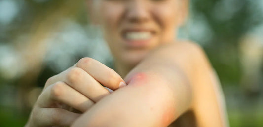 Woman with mosquito bite