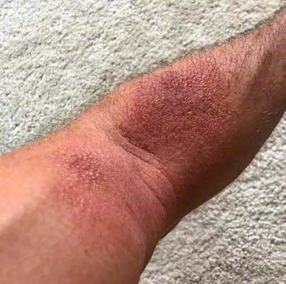 Severe Poison ivy rash on one arm.