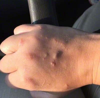 Poison ivy rash on the back of hand.