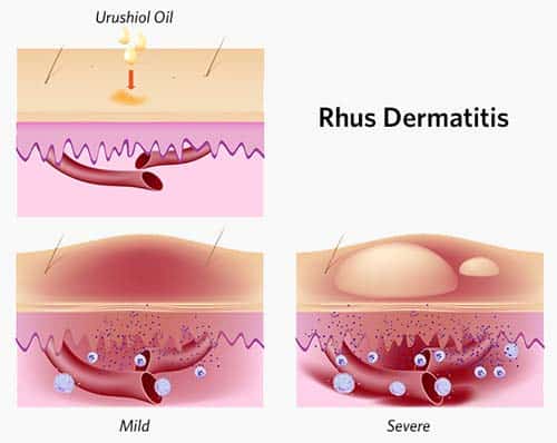An illustration of how Urushiol oil enters the skin and cause Rhus Dermatitis.