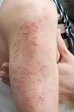 Contact Dermatitis on the upper arm due to an allergy.