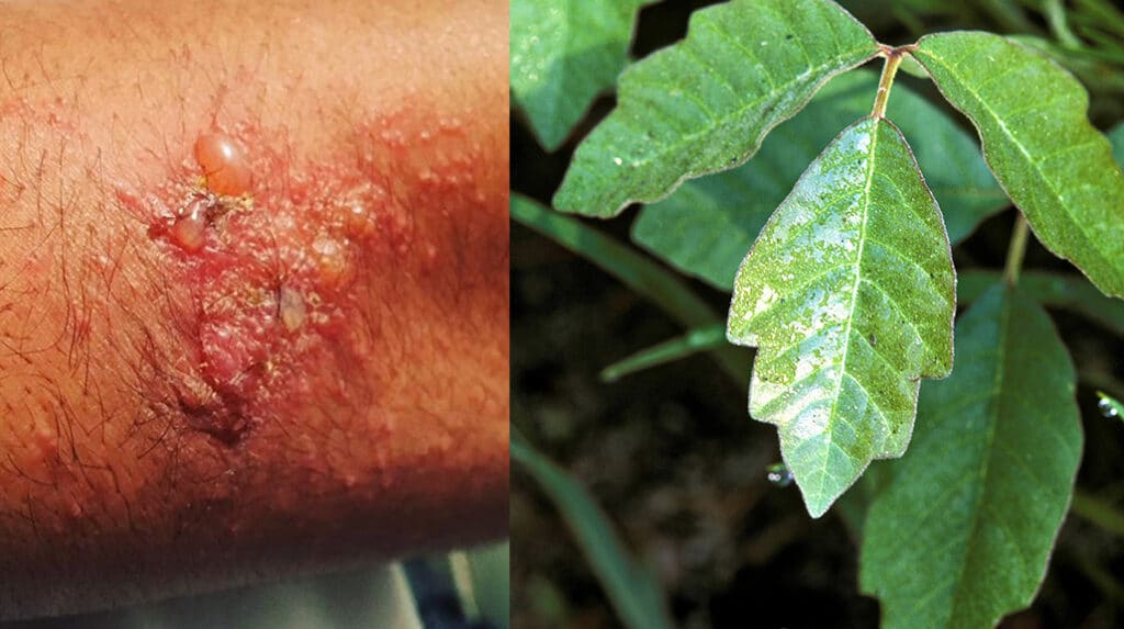 Poison Oak Rash effect on the skin.