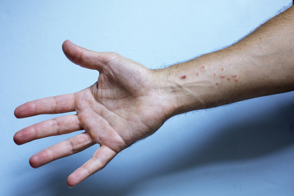 A man's wrist has some poison ivy blisters.