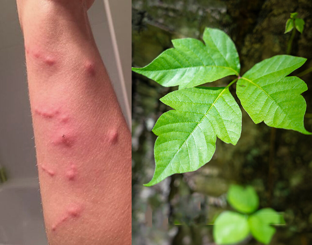 The left image shows an arm with poison ivy rash and the right image shows the poison ivy leaf.