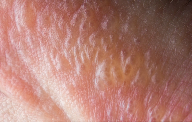 A closeup look on a poison ivy blisters on the skin. 